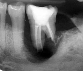 radiographie dentaire avec endodontie